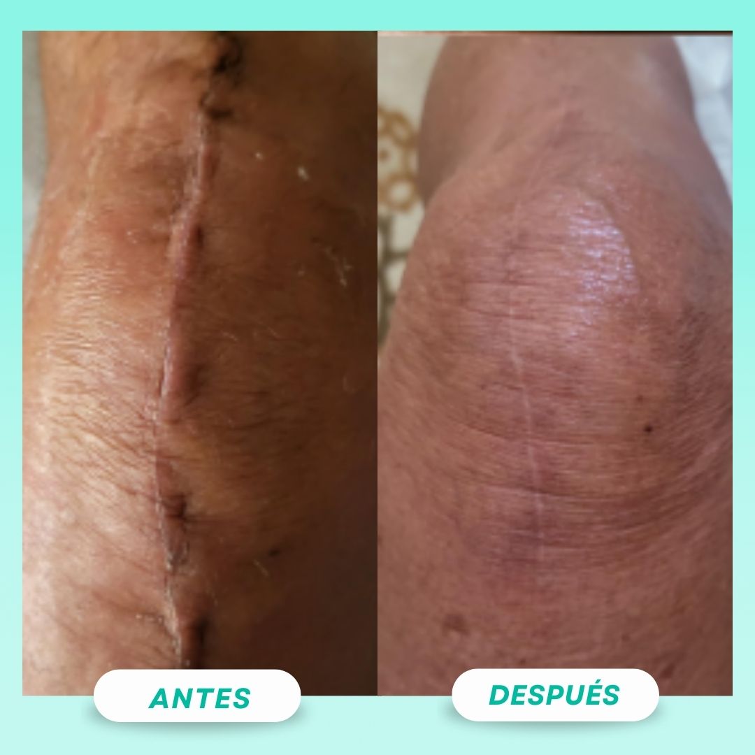 Sérum reparador de cicatrices y marcas - Skin Healt™